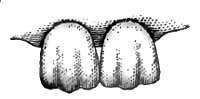 Serrations of Normal Incisors